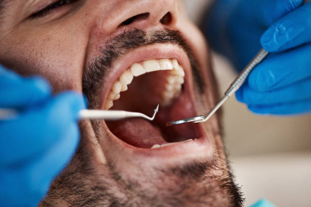 Best Emergency Tooth Extraction in Port Royal, SC